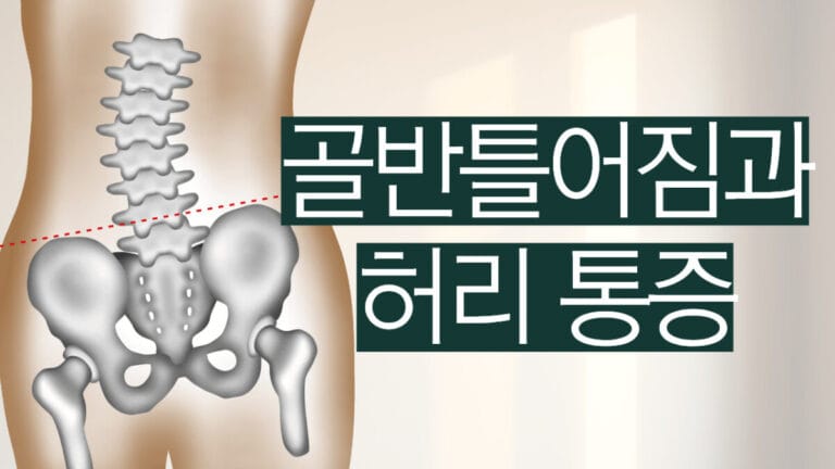 골반틀어짐과 허리 통증, 골반의 좌우 높이 차이를 표현한 그림